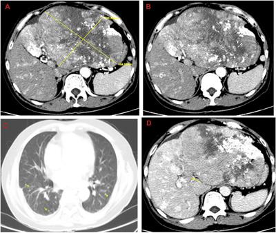 Case Report: One-Year Delay in the Effect of Conversion Surgery Therapy for Advanced Hepatocellular Carcinoma After Systemic Therapy